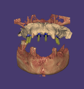 Captura Exoplan 1 Captura Exoplan 1